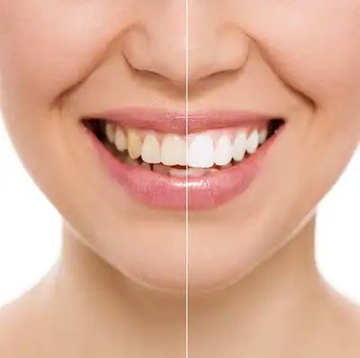How Much Does Teeth Whitening Cost in Namibia?